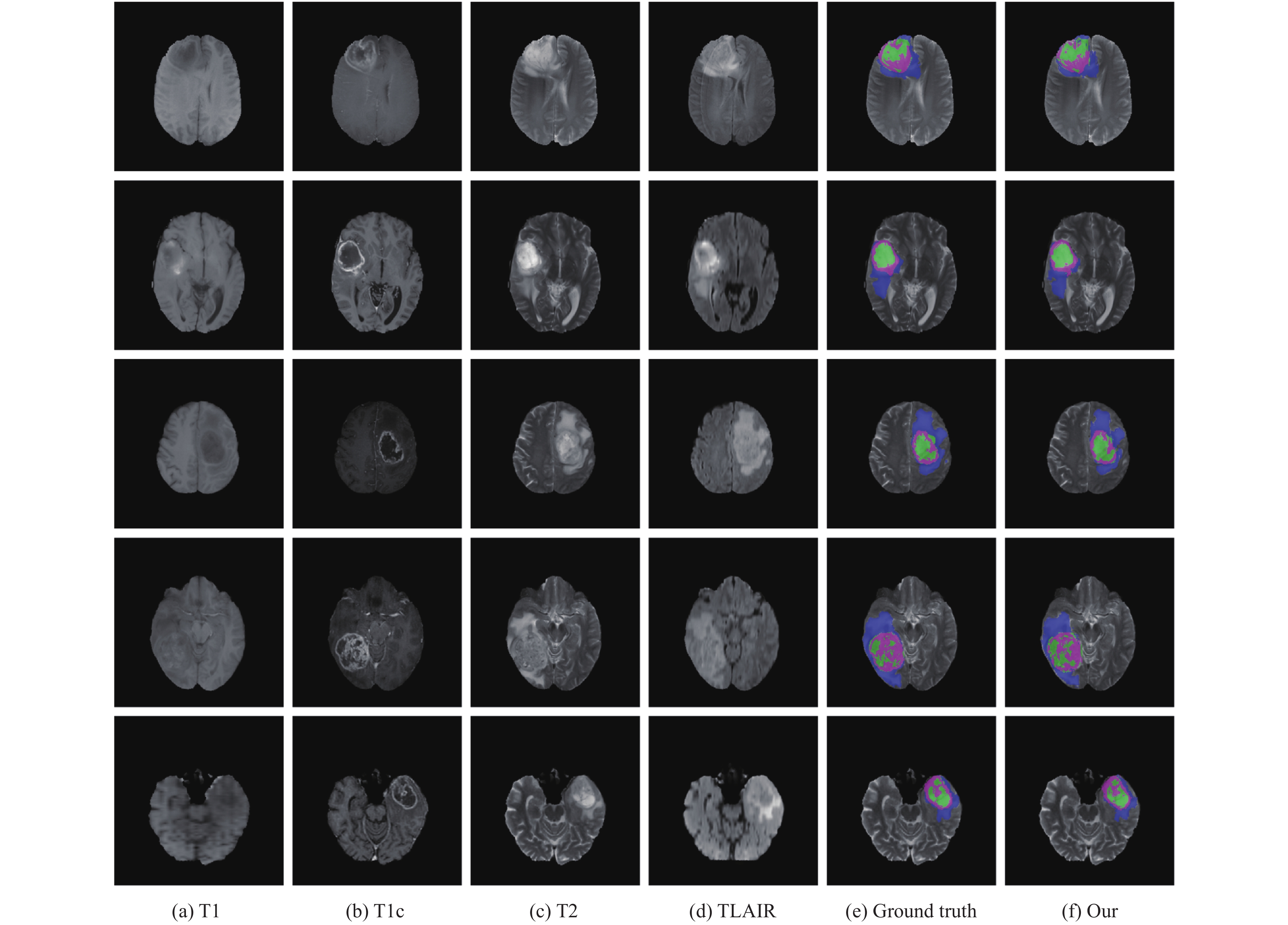 多模态磁共振成像及融合技术在颅脑恶性肿瘤放疗靶区勾画中的应用